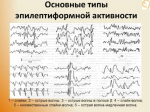 Изменения у ребенка ЭЭГ с элементами эпилептиформной активности