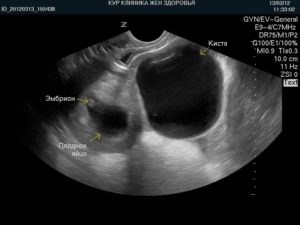 Киста по УЗИ и беременность