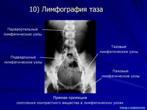 Лимфоаденопатия малого таза