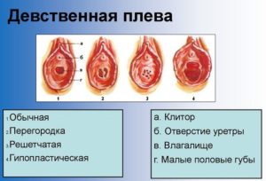 Килевидная девственная плева