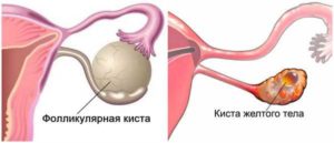 Киста жёлтого тела при приеме утрожестан