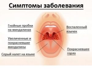 Ком в горле и постоянно воспалены гланды