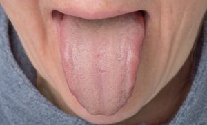 Болит горло и обложен язык