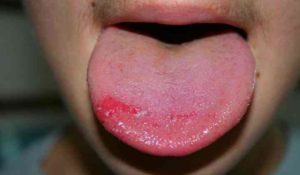 Круглые болячки на языке