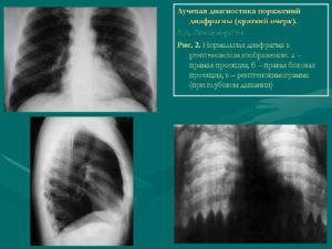 Корни усилены cos-n, релаксация обоих куполов диафрагмы