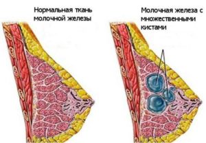 Мастопатия, выделения из соска