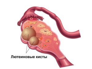 Киста желтого тела при кормлении