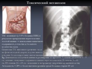 Мегадолихоколон субкомпенсированная форма