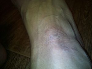 Болячка на ноге