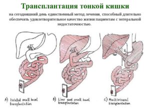 Пересадка тонкой кишки новорожденному