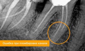 Болит запломбированный зуб без нерва