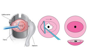 Лечение свечами Цервикон-Дим после конизации ШМ