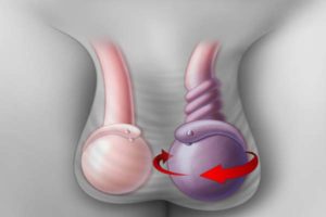 Боли после операции по перекруту яичка