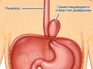 Исчезла грыжа пищевода