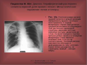 Бурление в легких, расшифруйте диагноз