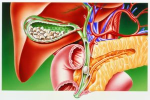 Камень в желчном протоке