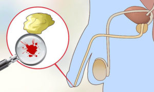 Кровь в моче и сперме