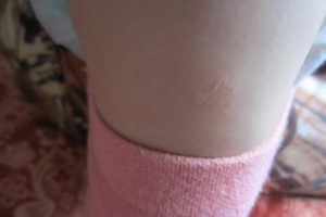 Красноватое сухое шелушащиеся пятно на ручке у ребёнка