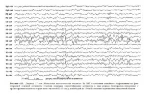 Изменения у ребенка ЭЭГ с элементами эпилептиформной активности
