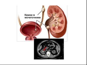 Камень в устье мочеточника