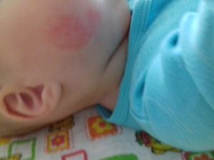 Красное пятно на щеке у малыша 4 месяца