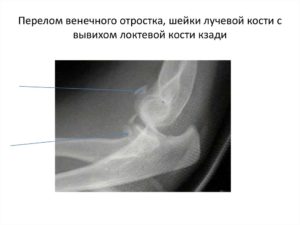 Перелом венечного отростка локтевой кости