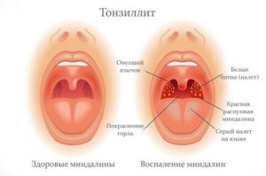 Кровь при тонзиллите