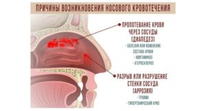 Болит голова, сгустки крови при сморкании