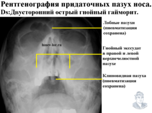 Какое заключение по рентгену прид. Пазухи носа?