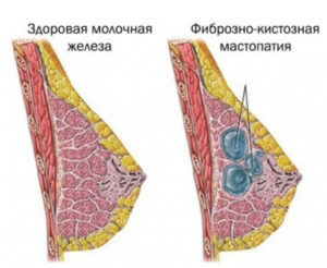 Мастопатия молочных желез 2-ой степени