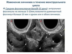 Мало или норма фолликул в яичниках