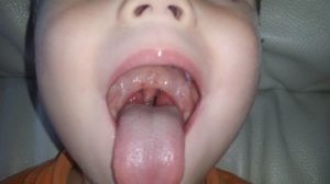 Красное горло и боли во рту у ребёнка