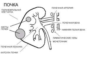 Киста в лоханках почек