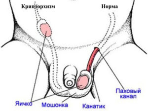 Крипторхизм неопущенное яичко