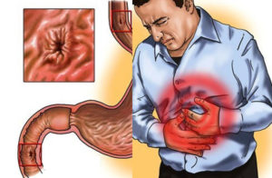 Cuanto dura una gastritis aguda