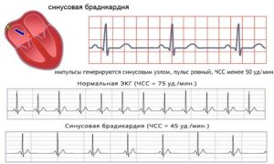 Брадикардия и низкое давление