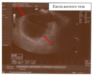 Киста желтого тела, очень болит