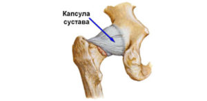 Лопнула суставная капсула