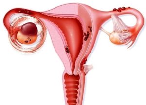 Киста яичника и тонкий эндометрий при планировании беременности