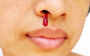 Кровь из носа через рот