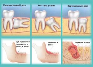 Больно открывать рот, зуб мудрости