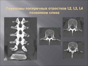 Перелом правого поперечного отростка