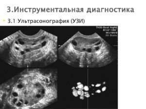 Кистозные изменения яичников