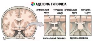 Как похудеть при аденоме гипофиза?