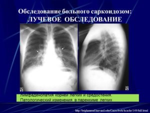 Лимфоаденопатия средостения, очаговые поражения лёгких