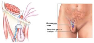 Болезненность в области паха после опер. С лапароскопией через 2 недели