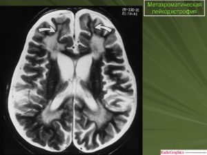 Лейкодистрофия под вопросом