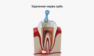 Болит зуб после наложения лекарства