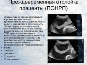 Как диагностировать отторжение металлоконструкциии и её повреждения