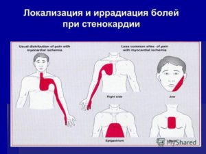 Боли в плече, желудке и иррадиация в сердце